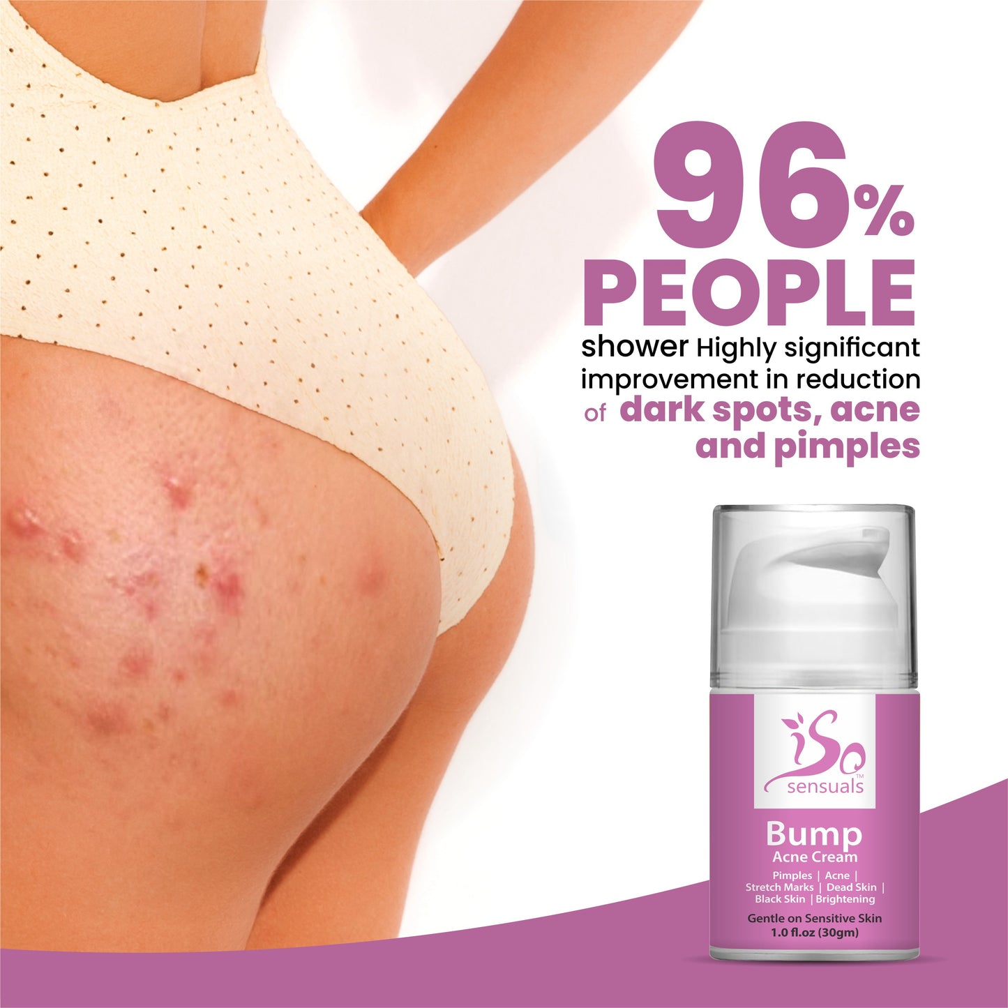 Bump Acne Brightening Cream for Clearing Acne Pimples Stretch Marks Black Skin