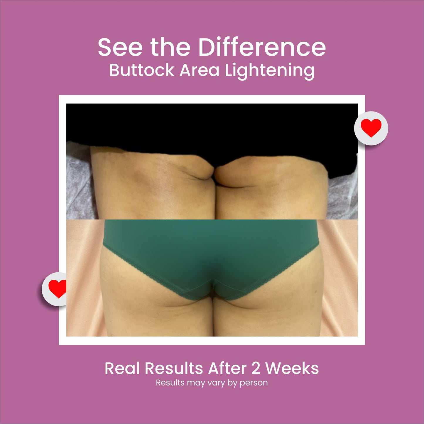 Bump Acne Brightening Cream for Clearing Acne Pimples Stretch Marks Black Skin