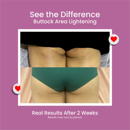 Bump Acne Brightening Cream for Clearing Acne Pimples Stretch Marks Black Skin