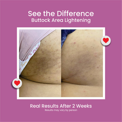 Bump Acne Brightening Cream for Clearing Acne Pimples Stretch Marks Black Skin