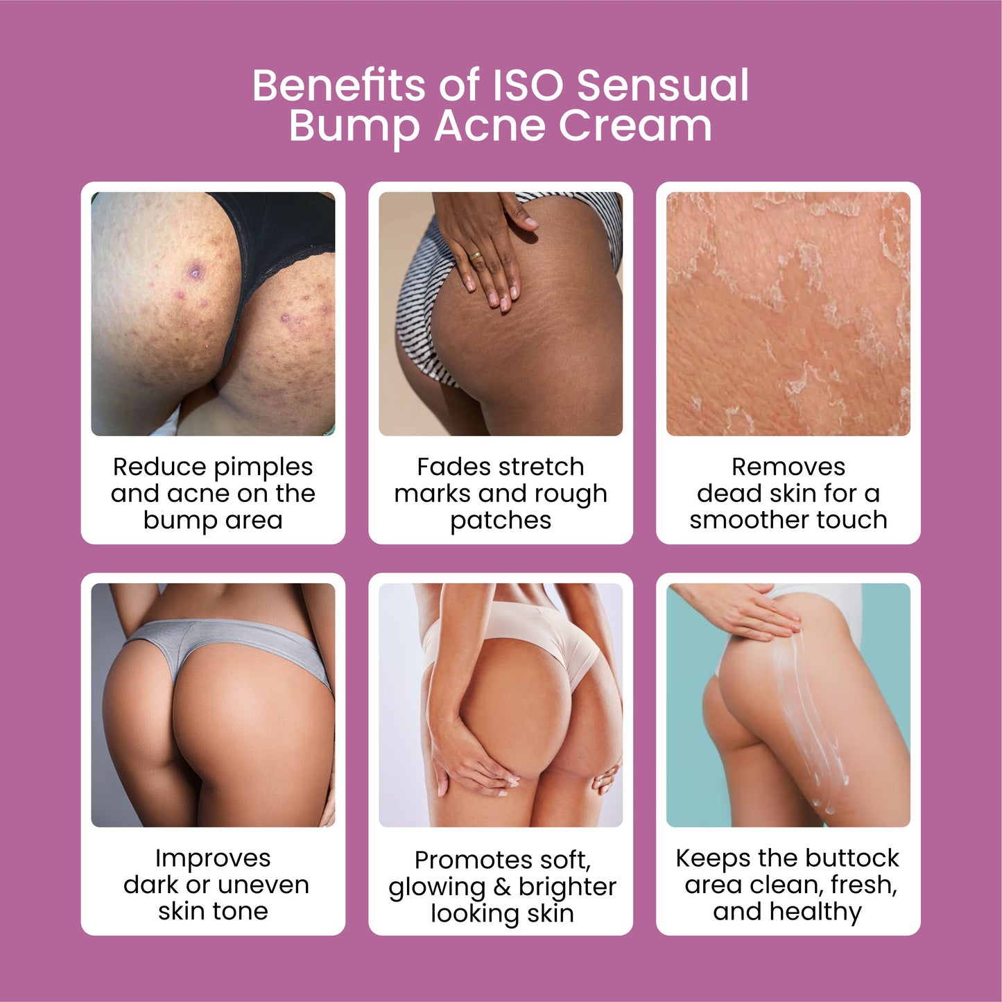 Bump Acne Brightening Cream for Clearing Acne Pimples Stretch Marks Black Skin